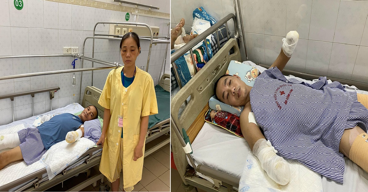 Quỹ từ thiện Xuân Thời thông tin về trường hợp hai bệnh nhân dưới đây đều đã phải cắt bỏ hai bàn tay tại bệnh viện Bỏng Quốc Gia.